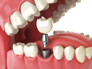 tooth implant dentist in tampa